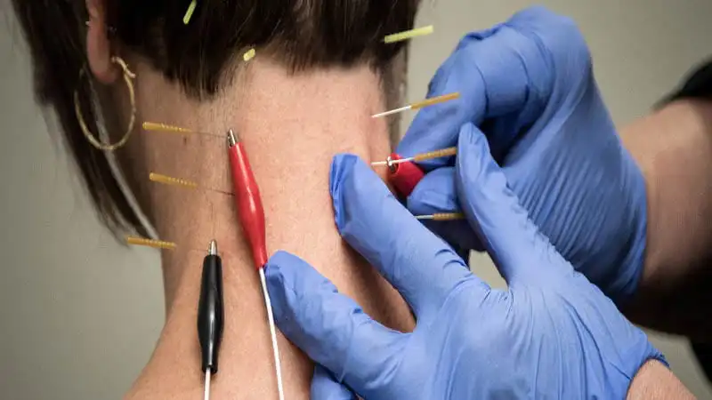 طب سوزنی (سوزن خشک: dry needling)