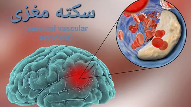 سکته مغزی چیست؟ علت، علائم، تشخیص و روش های درمان