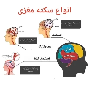 انواع سکته مغزی 