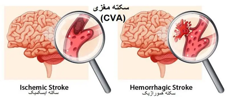درمان بیمار سکته مغزی(CVA) با فیزیوتراپی و کاردرمانی