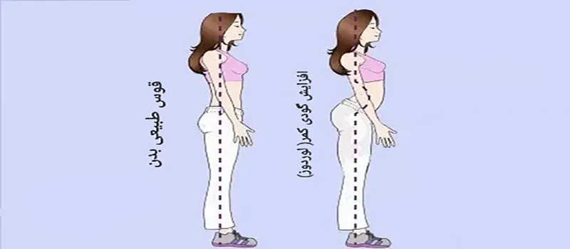 مقایسه گودی کمر و حالت طبیعی انحنا ستون فقرات