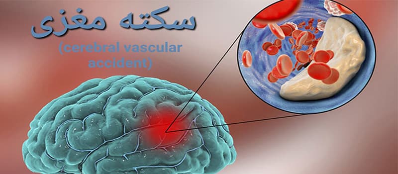 خدمات کاردرمانی و فیزیوتراپی سکته مغزی