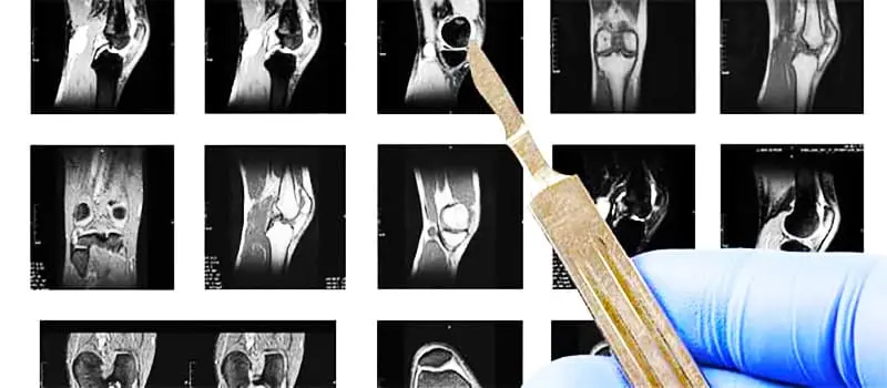 MRI یکی از روش‌های تشخیص درد زانو است.