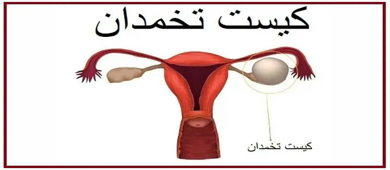 کیست تخمدان و اثر آن در درد سمت چپ و پایین شکم در بانوان 