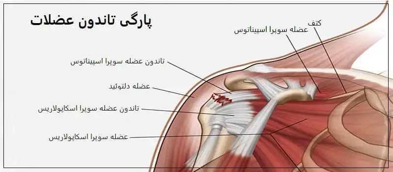 پارگی تاندون عضلات روتاتور کاف یکی از علل بروز درد شانه است.