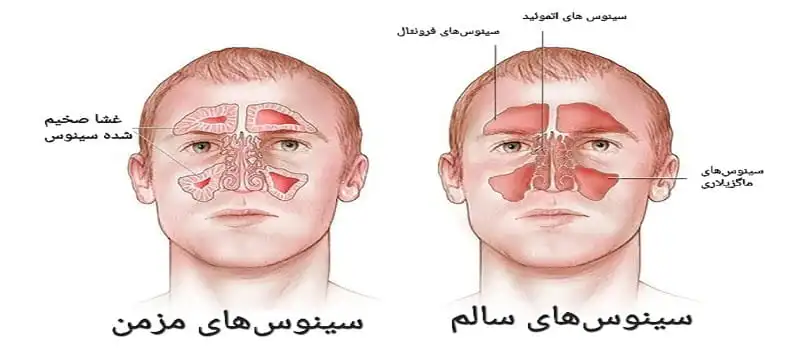 انواع سینوس‌ها