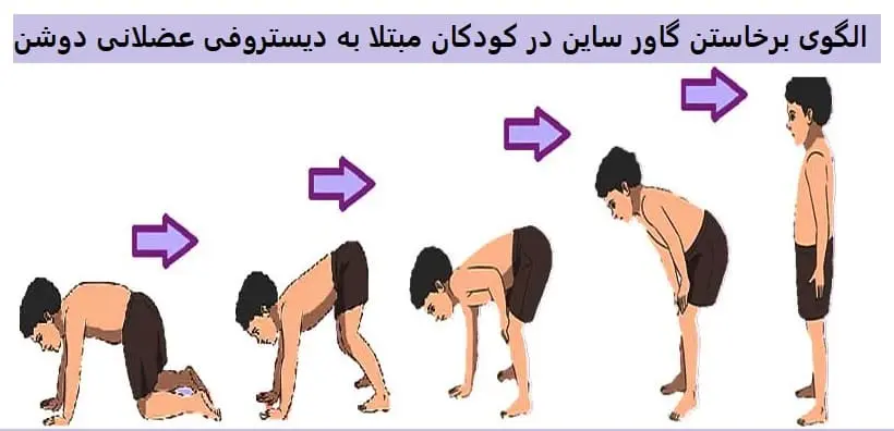 الگوی راه رفتن گاور ساین در کودکان مبتلا به دیستروفی عضلانی دوشن