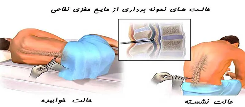 یکی از راه های تشخیص سندرم گیلن باره، انجام سوراخ کمری (lumbar puncture) برای تجزیه و تحلیل مایع مغزی نخاعی میباشد.