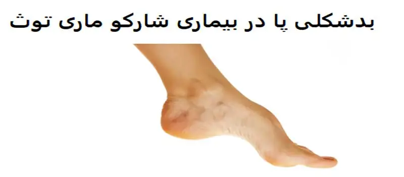 بدشکلی پا در بیماری شارکو ماری توث