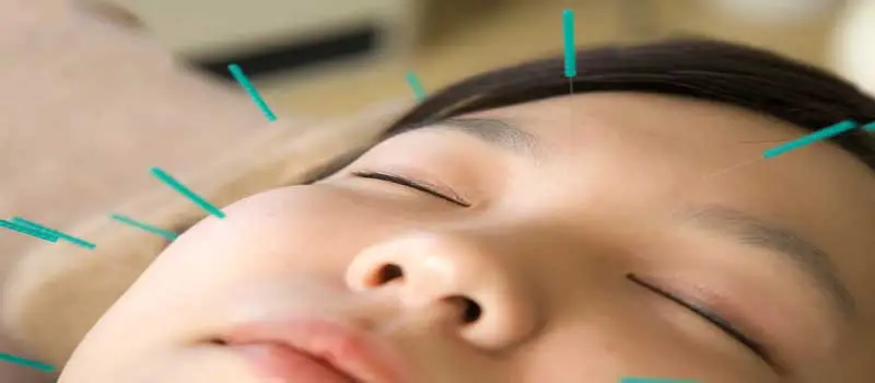 توانبخشی و نیدلینگ برای فلج بلز