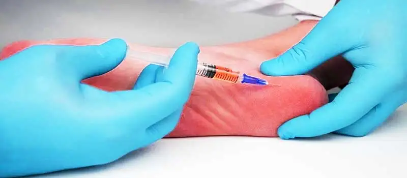 تزریق کورتون برای کنترل التهاب ناشی از خار پاشنه