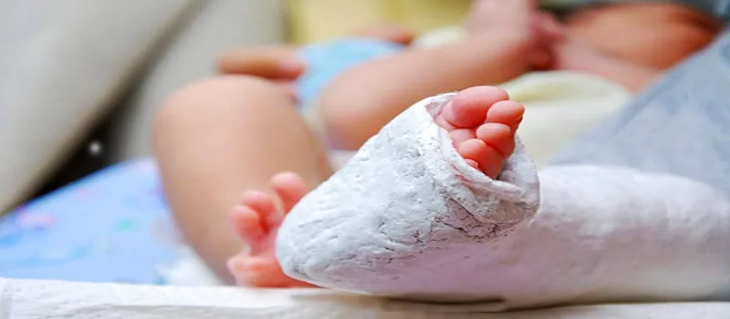 گچ گیری برای اصلاح فرم پای کودکان کلاب فوت