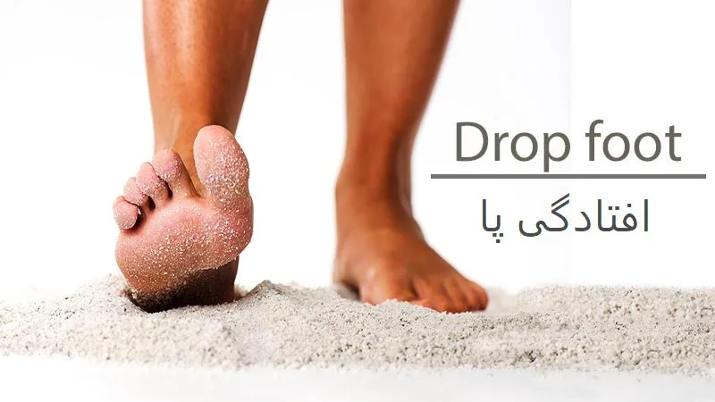 آشنایی با افتادگی مچ و دلایل بروز آن