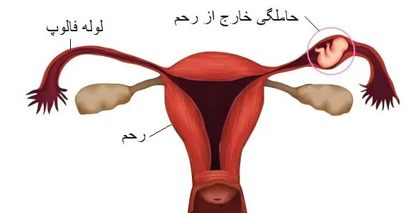 درد سمت چپ شکم در زنان