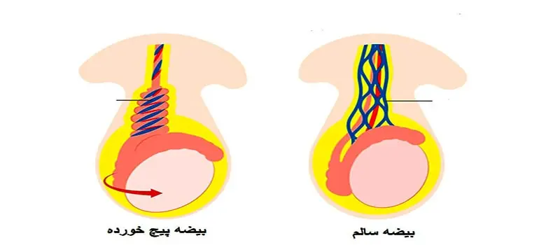 درد سمت چپ شکم در مردان